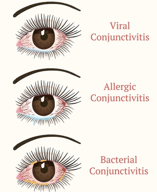 Types of Conjunctivitis